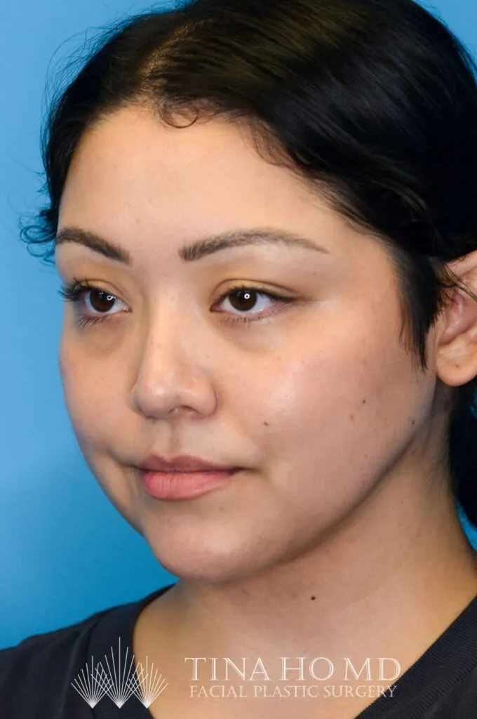 Person's left oblique after neck lift with enhanced definition and smoothness