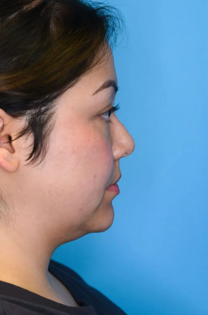 Person's right profile before neck lift showing loose skin and jowls