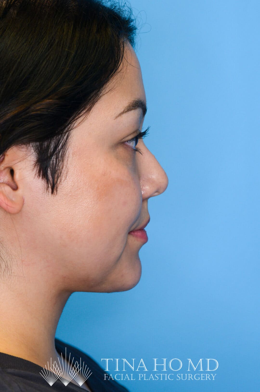 Person's right profile after neck lift with smoother, tighter jawline