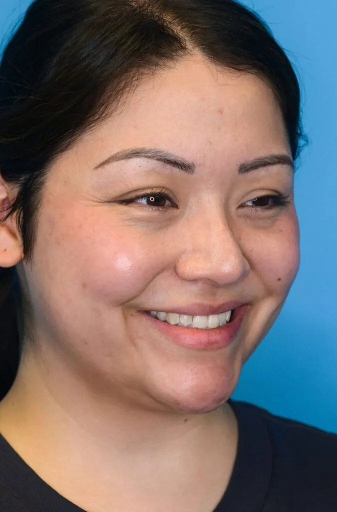 Person's right oblique view before neck lift showing submental fullness