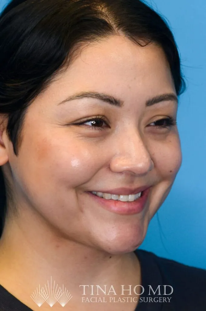 Person's right oblique view after neck lift with improved neck contour