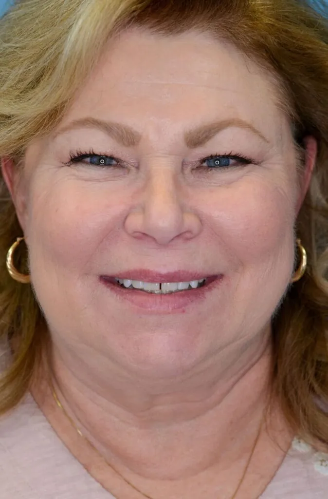 Person's frontal view before facelift and deep plane neck lift showing neck fullness