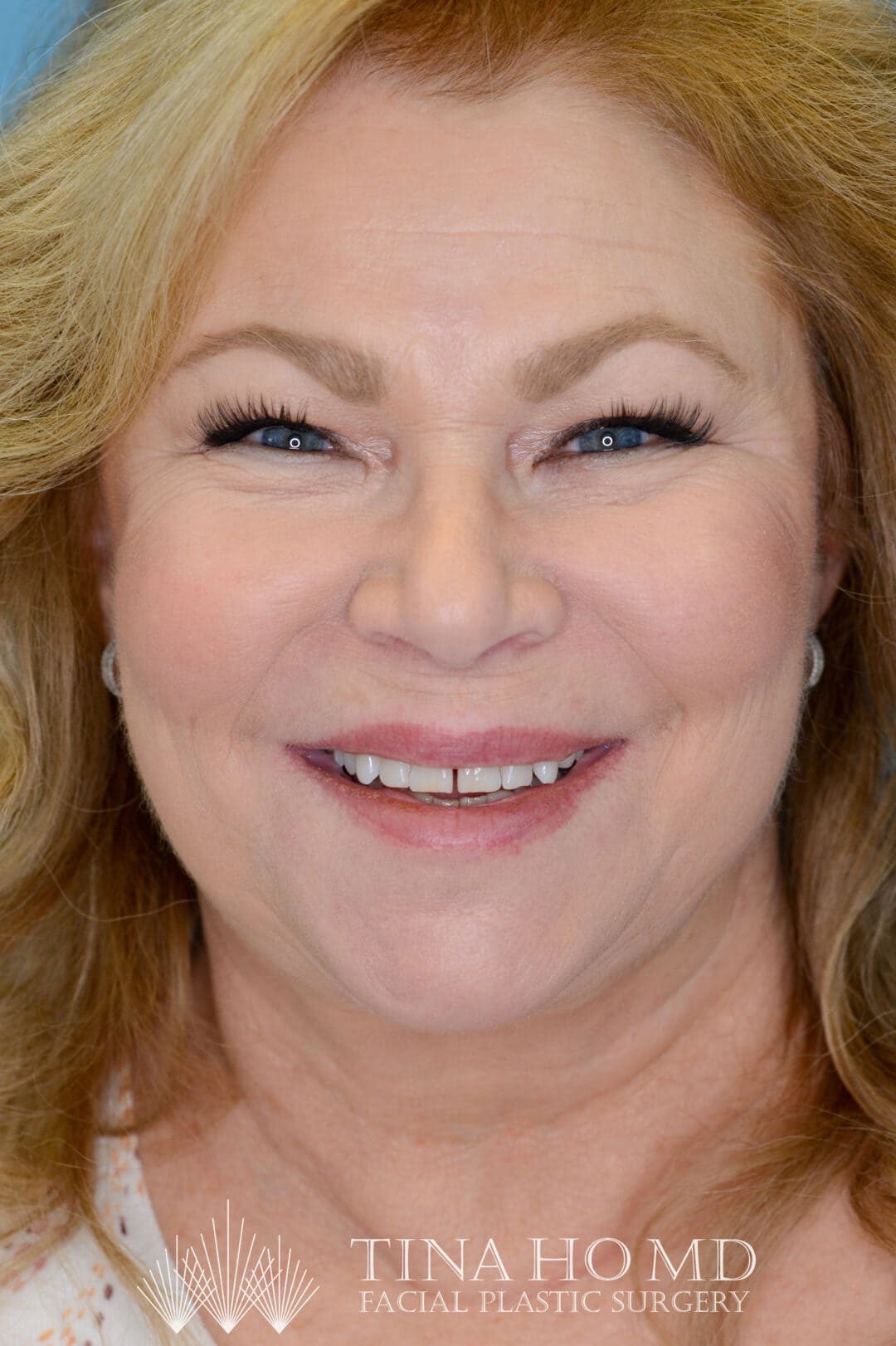 Person's frontal view after facelift and deep plane neck lift with a smoother neck