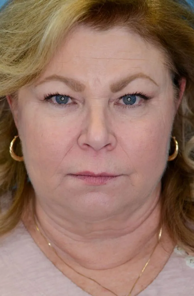 Person's frontal view before facelift and deep plane neck lift showing undefined jawline