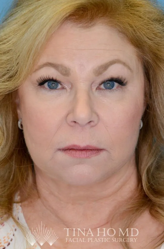 Person's frontal view after facelift and deep plane neck lift with improved jawline
