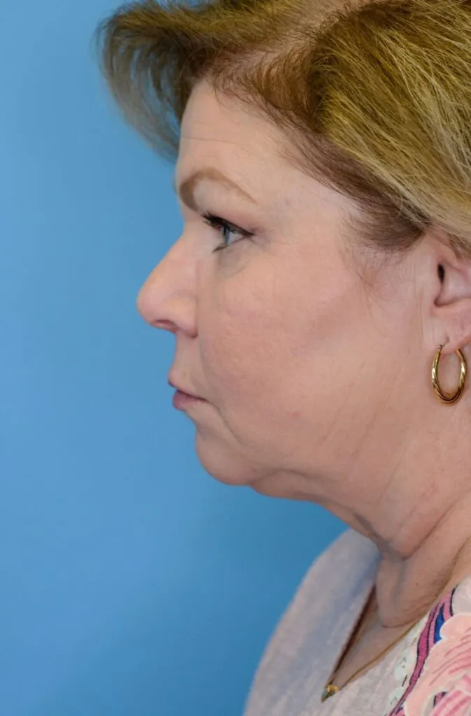 Person's left lateral profile before facelift and deep plane neck lift procedure