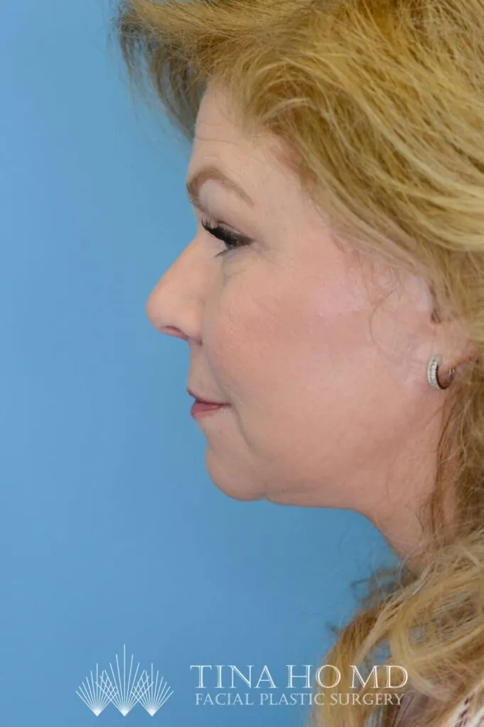 Person's left lateral profile after facelift and deep plane neck lift with improvement