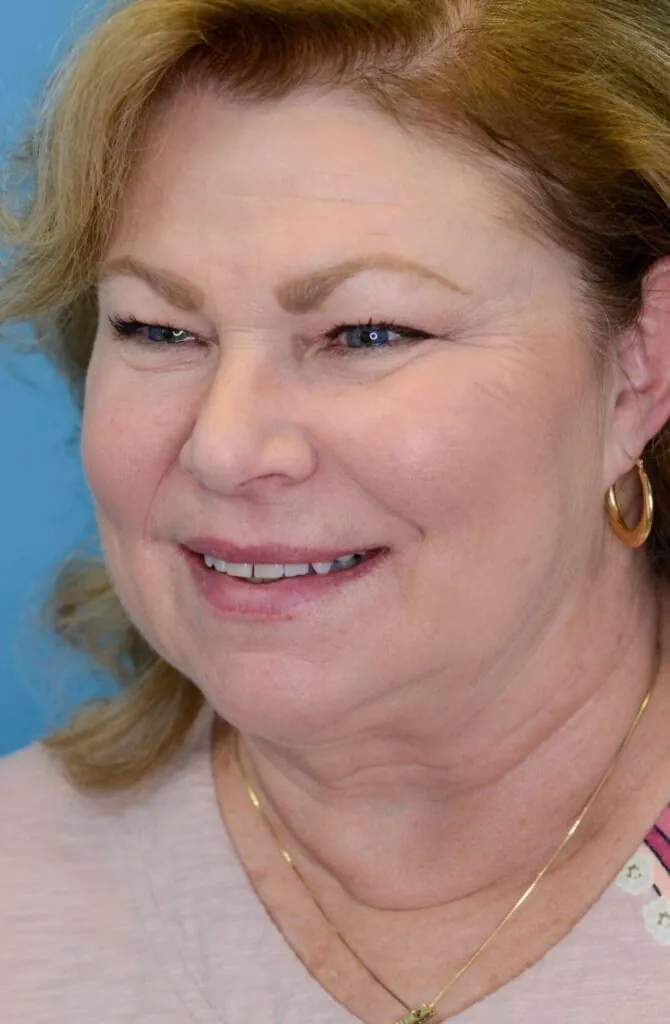 Person's left oblique view before facelift and deep plane neck lift showing loose skin