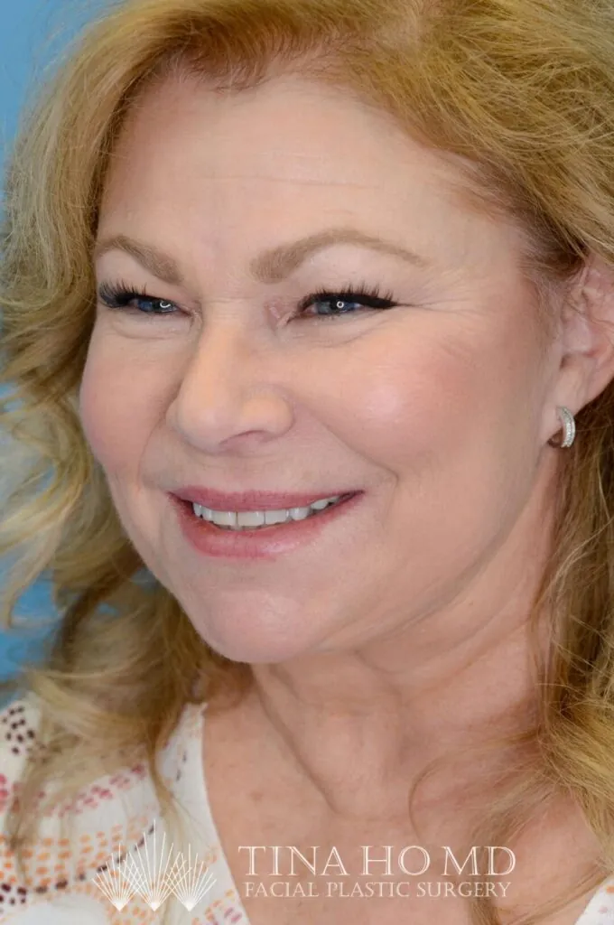 Person's left oblique view after facelift and deep plane neck lift with a tighter neck