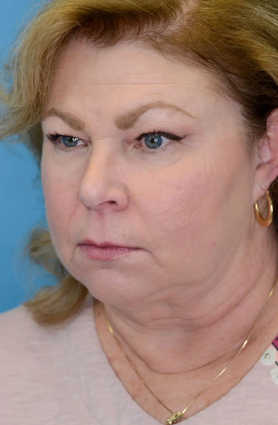 Person's left oblique view before facelift and deep plane neck lift procedure