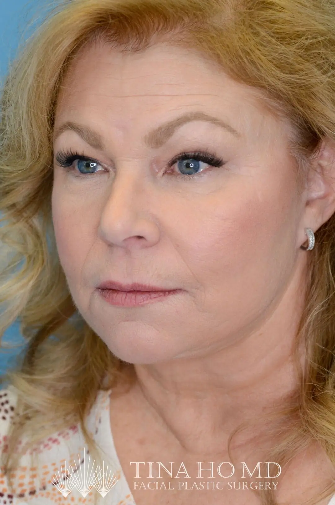 Person's left oblique view after facelift and deep plane neck lift showing results