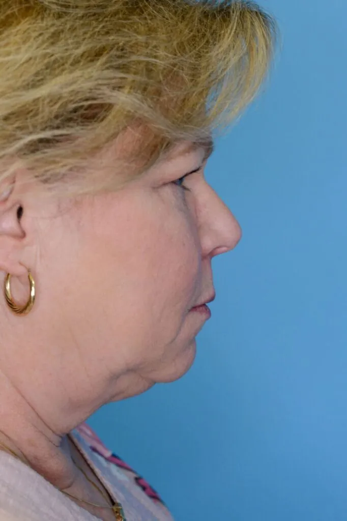 Person's right lateral profile before facelift and deep plane neck lift showing jowls