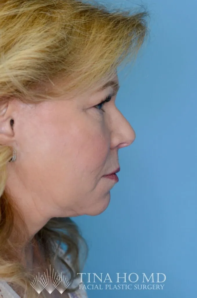 Person's right lateral profile after facelift and deep plane neck lift with a firm jawline