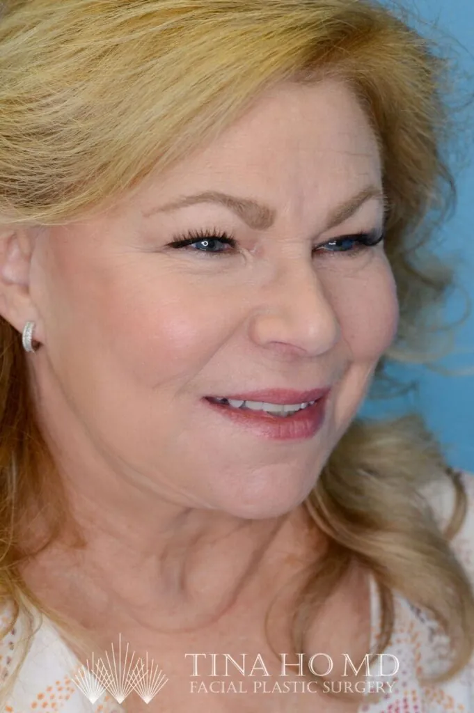 Person's right oblique view after deep plane neck lift and facelift procedure