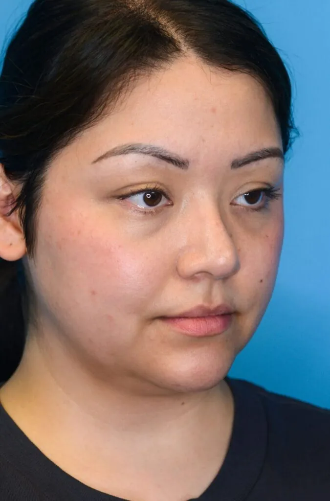 Person's facial profile before a deep plane neck lift procedure
