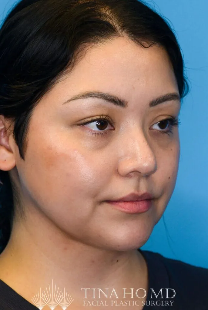 Person's facial profile after a deep plane neck lift showing improvement