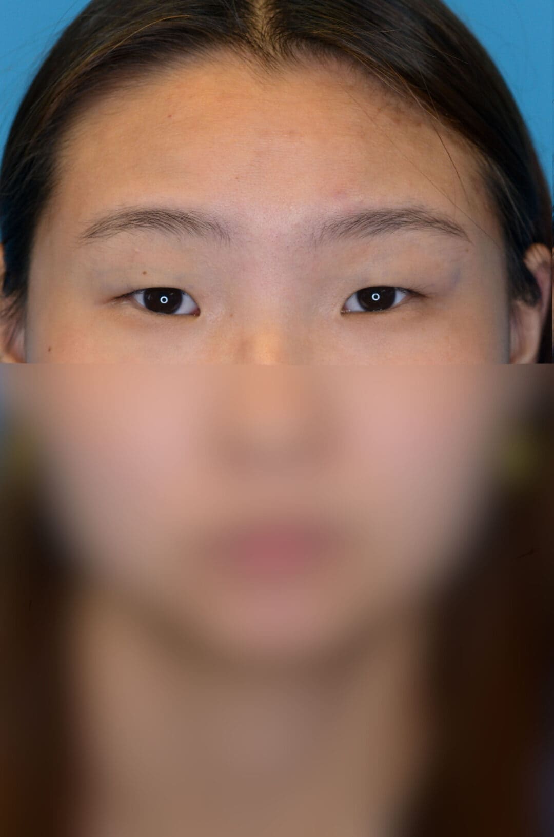 Patient JL facing forward before upper blepharoplasty in Philadelphia