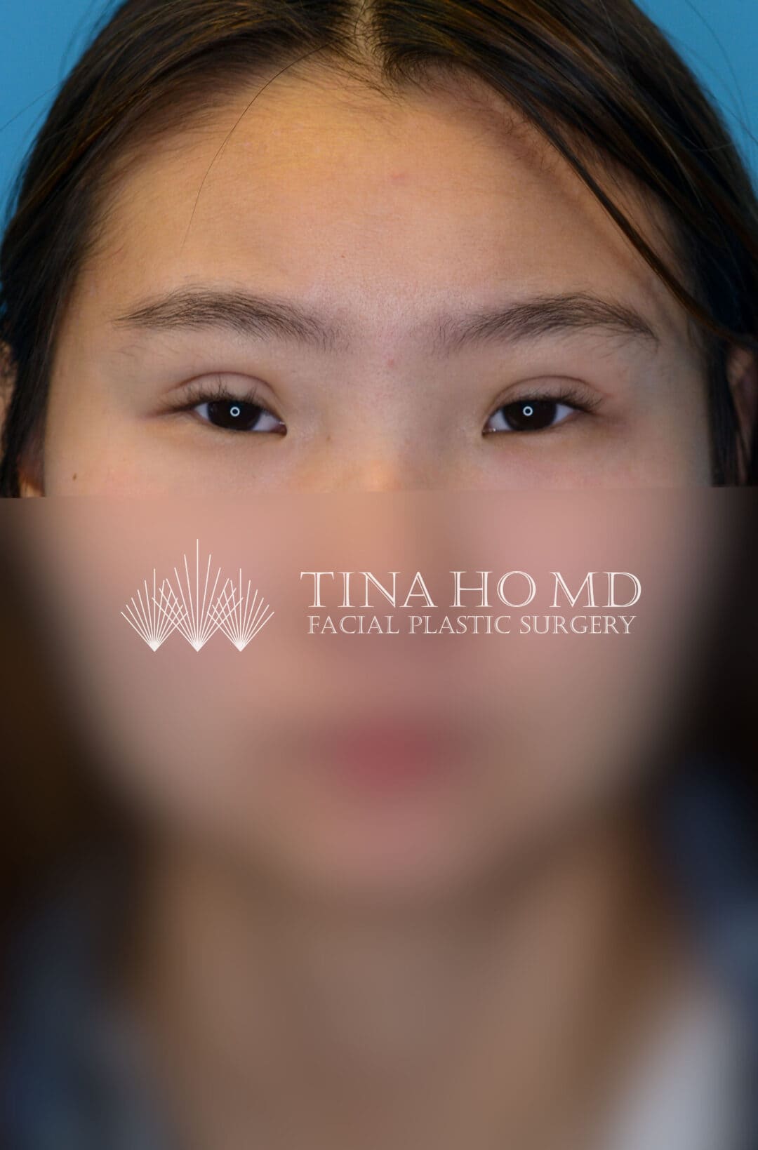 Patient JL facing forward after upper blepharoplasty in Philadelphia