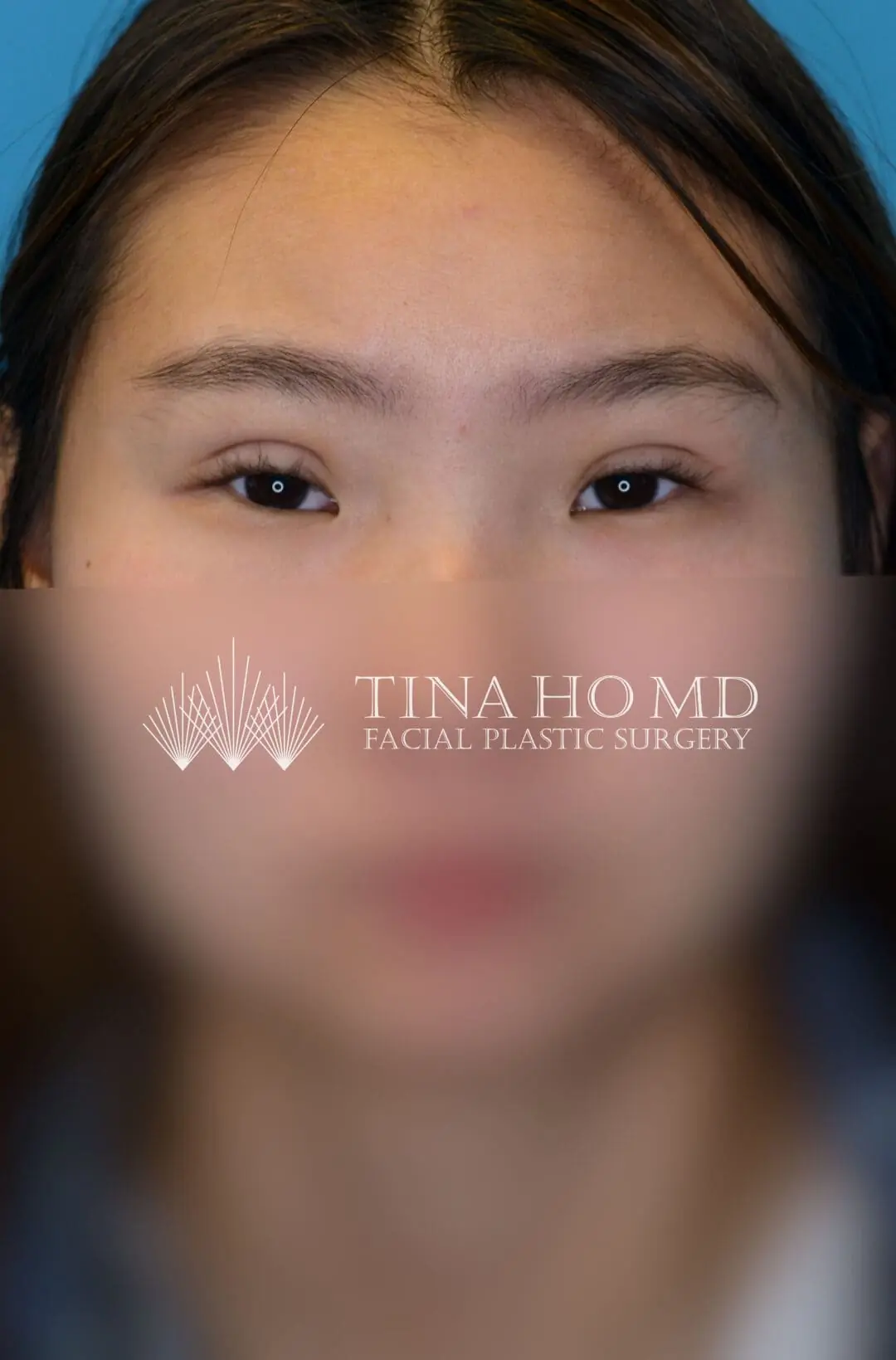 Patient JL facing forward after upper blepharoplasty in Philadelphia