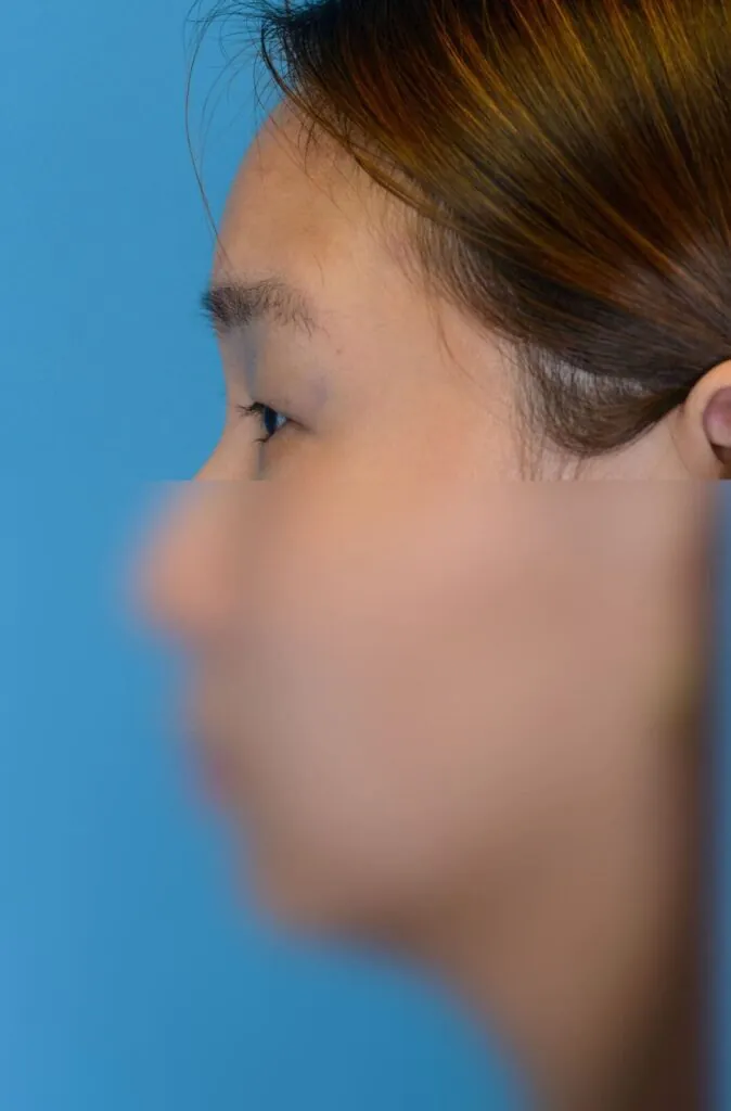 Patient JL left lateral view before upper blepharoplasty in Philadelphia