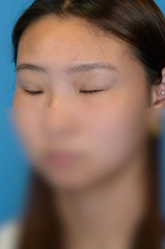 Patient JL left oblique view before upper blepharoplasty in Philadelphia