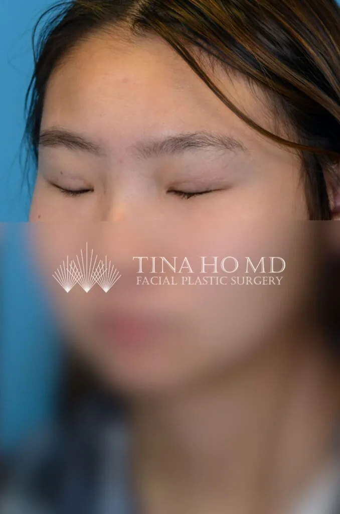 Patient JL left oblique view after upper blepharoplasty in Philadelphia