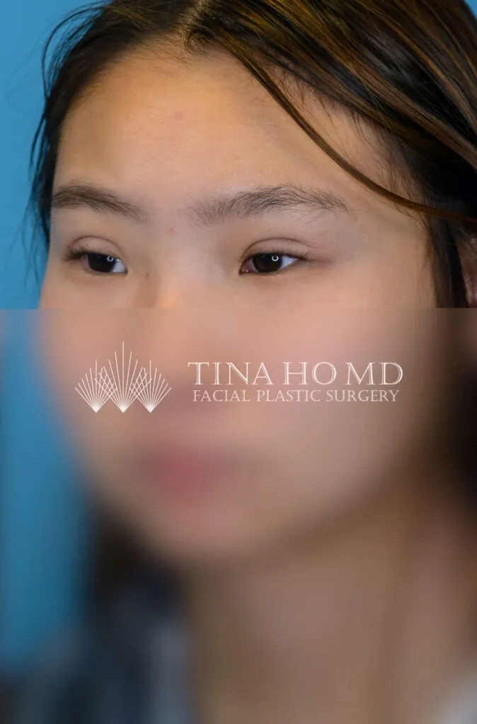 Patient JL left oblique view after upper blepharoplasty in Philadelphia