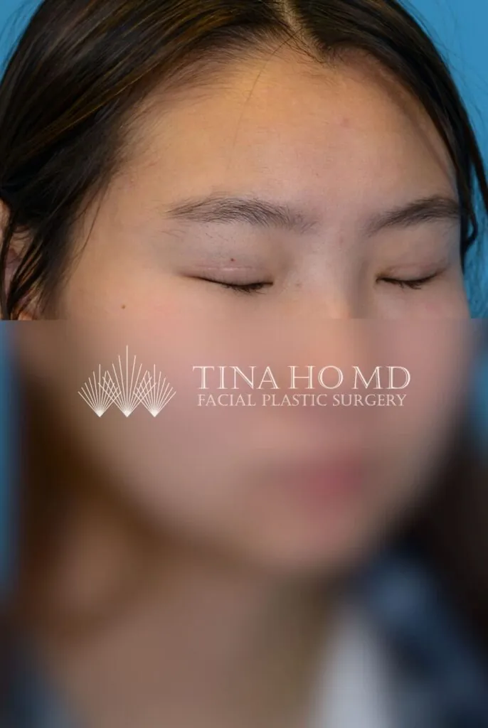 Patient JL right oblique view after upper blepharoplasty in Philadelphia