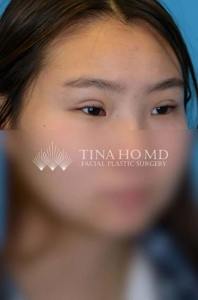 Patient JL right oblique view after upper blepharoplasty in Philadelphia