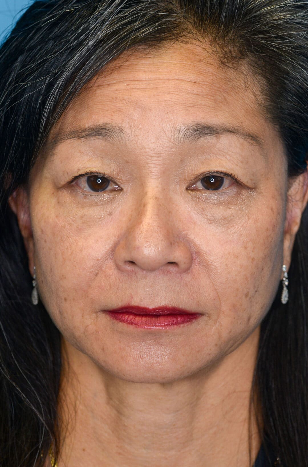 Patient JW facing forward before upper blepharoplasty in Philadelphia