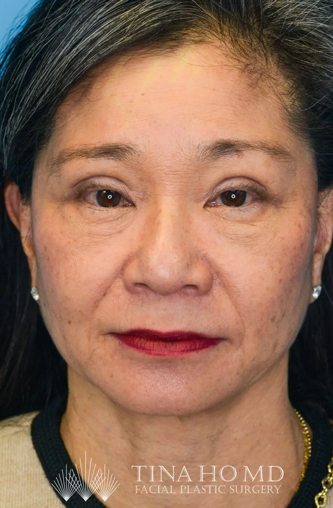Patient JW facing forward after upper blepharoplasty in Philadelphia
