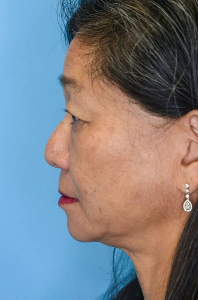 Patient JW left lateral view before upper blepharoplasty in Philadelphia