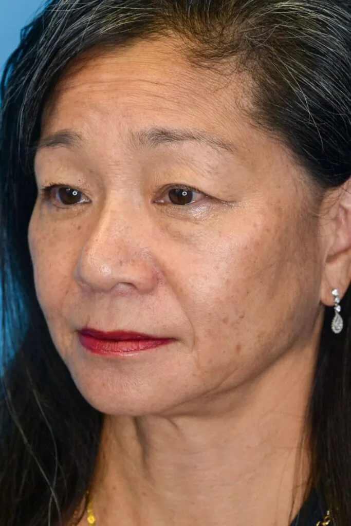 Patient JW left oblique view before upper blepharoplasty in Philadelphia