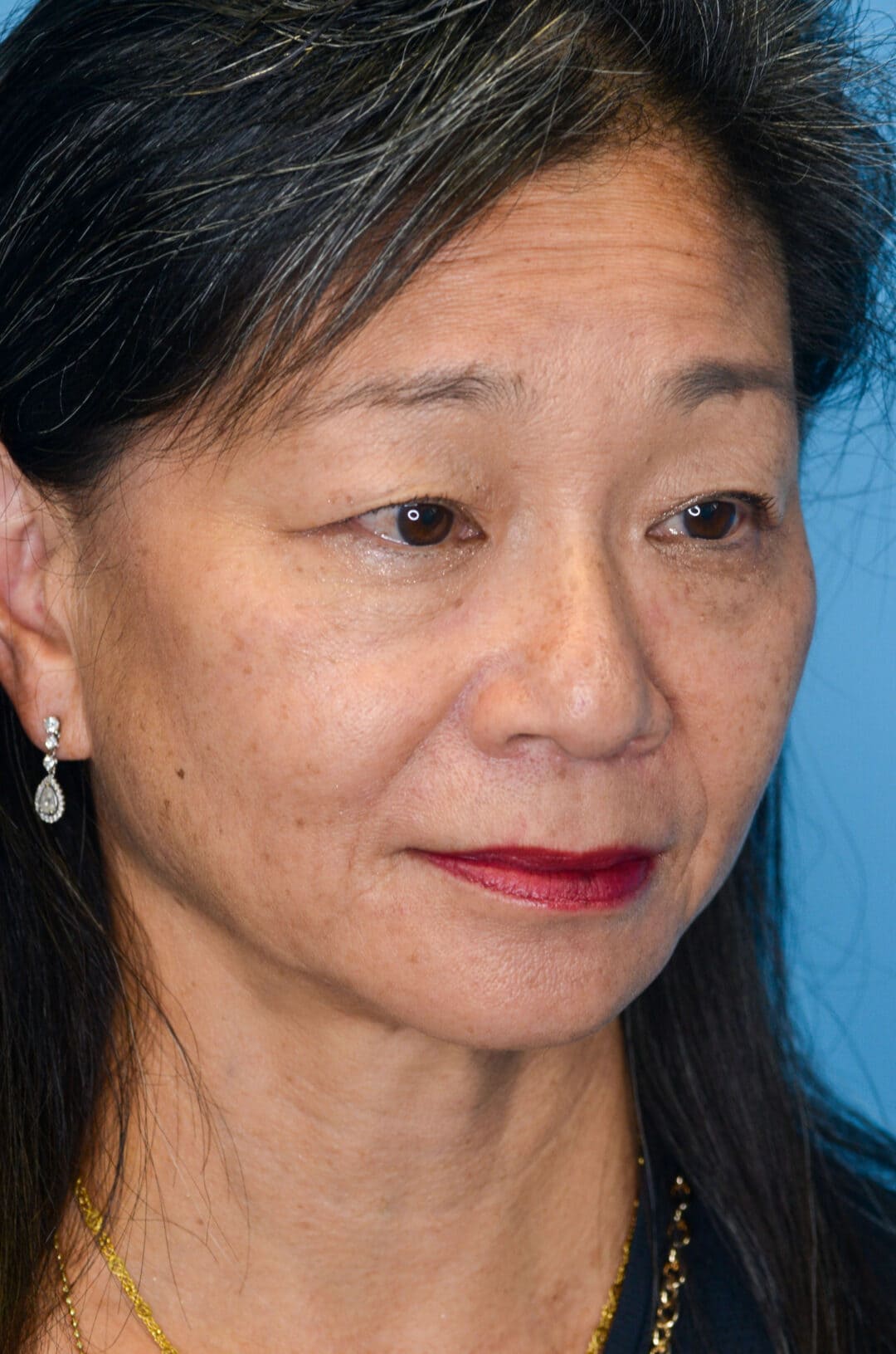 Patient JW right oblique view before upper blepharoplasty in Philadelphia