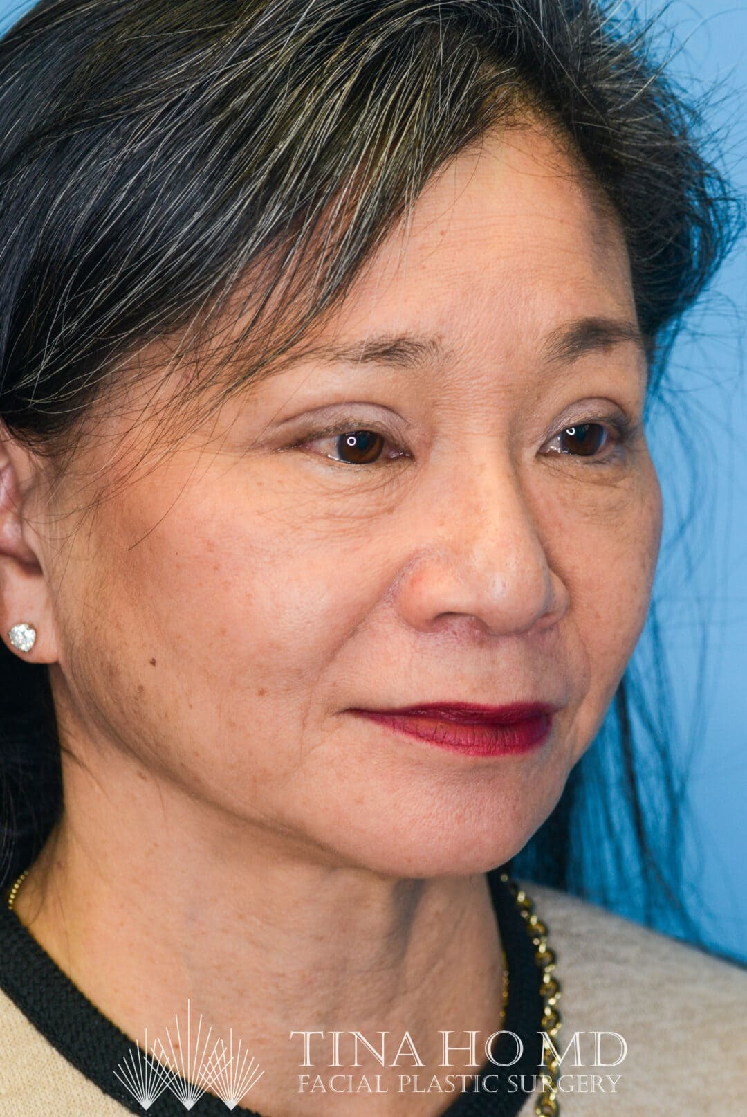 Patient JW right oblique view after upper blepharoplasty in Philadelphia