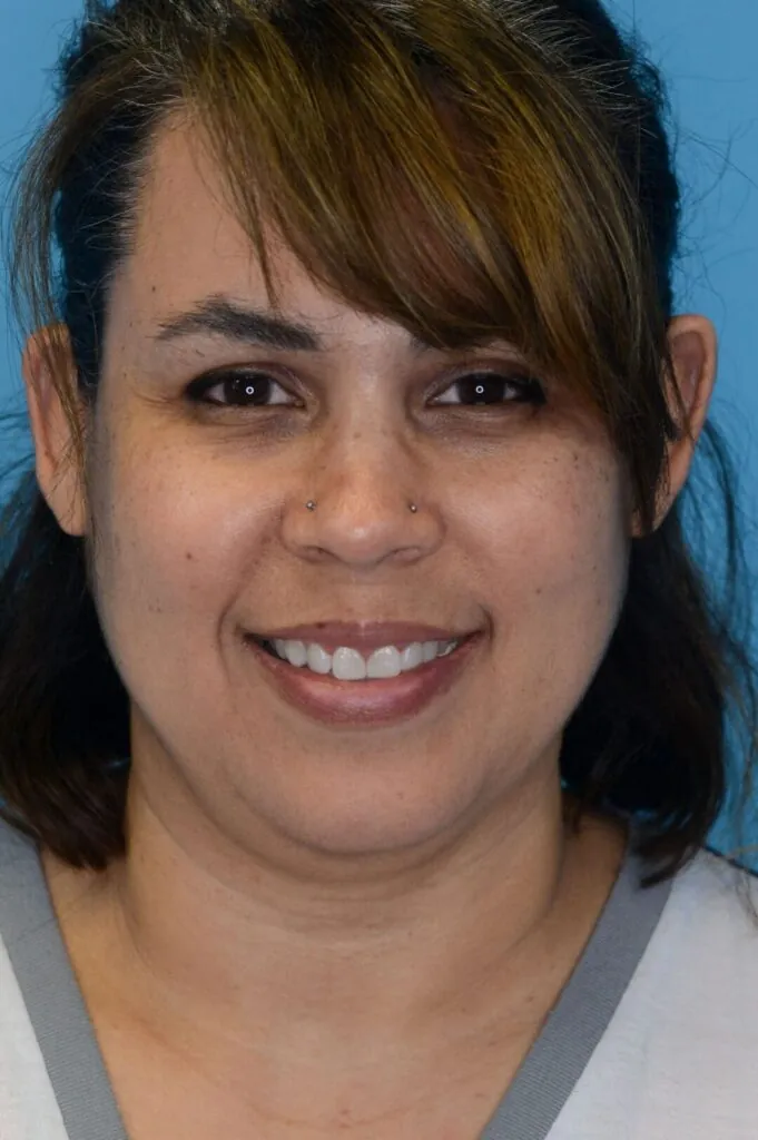 Patient LR's frontal view, before facelift surgery