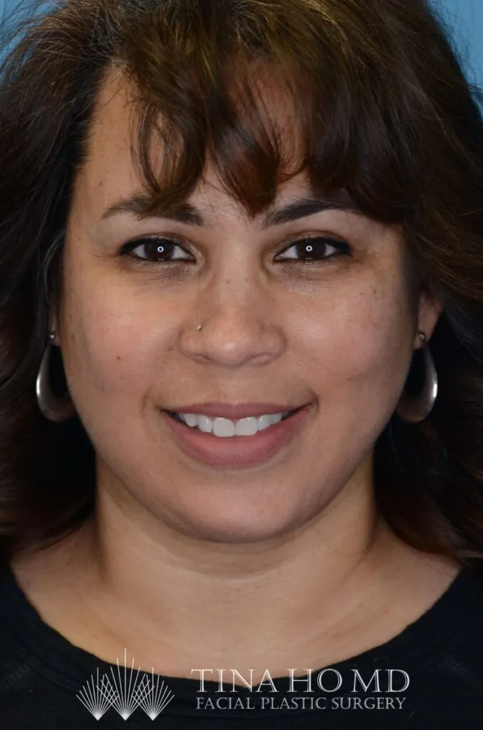 Patient LR's frontal view, showing improved facial contours after surgery