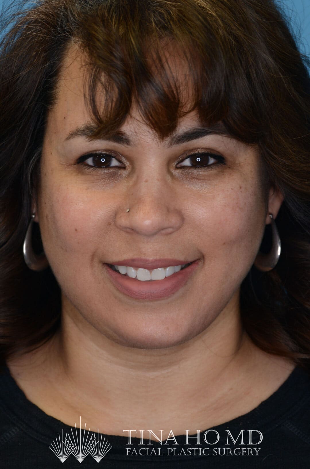 Patient LR's frontal view, showing improved facial contours after surgery