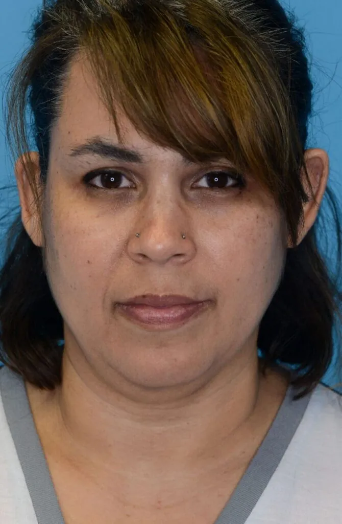 Patient LR's frontal view, before facelift surgery