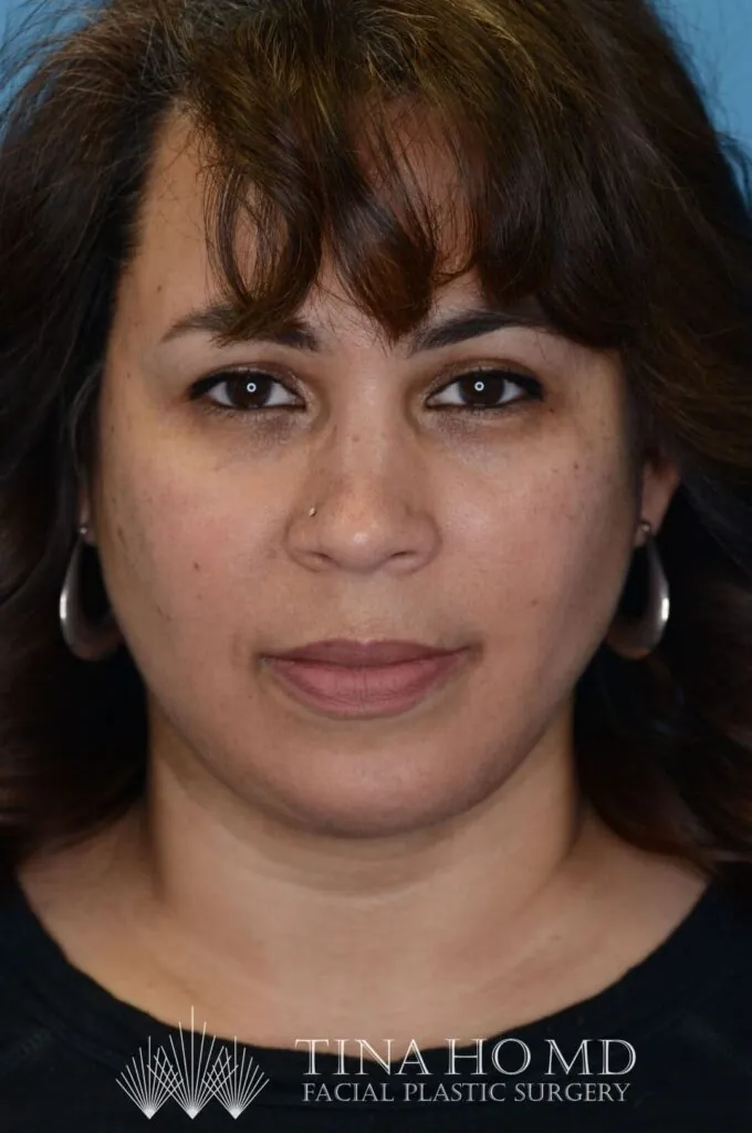 Patient LR's frontal view, showing improved facial contours after surgery