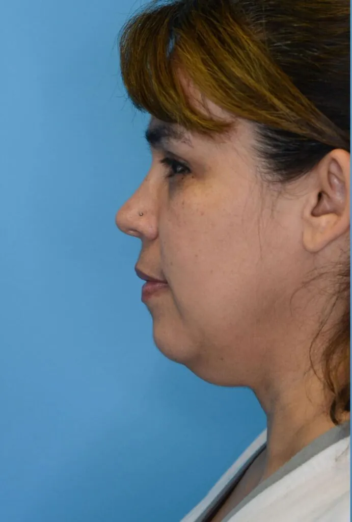 Patient LR's left lateral view, before facelift surgery