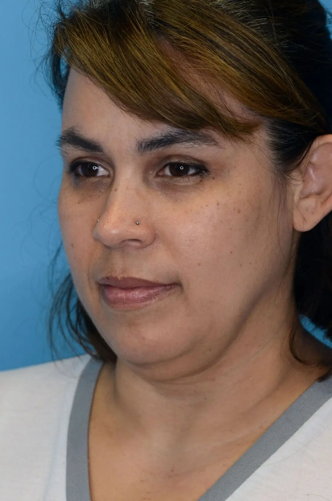 Patient LR's left oblique view, before facelift surgery