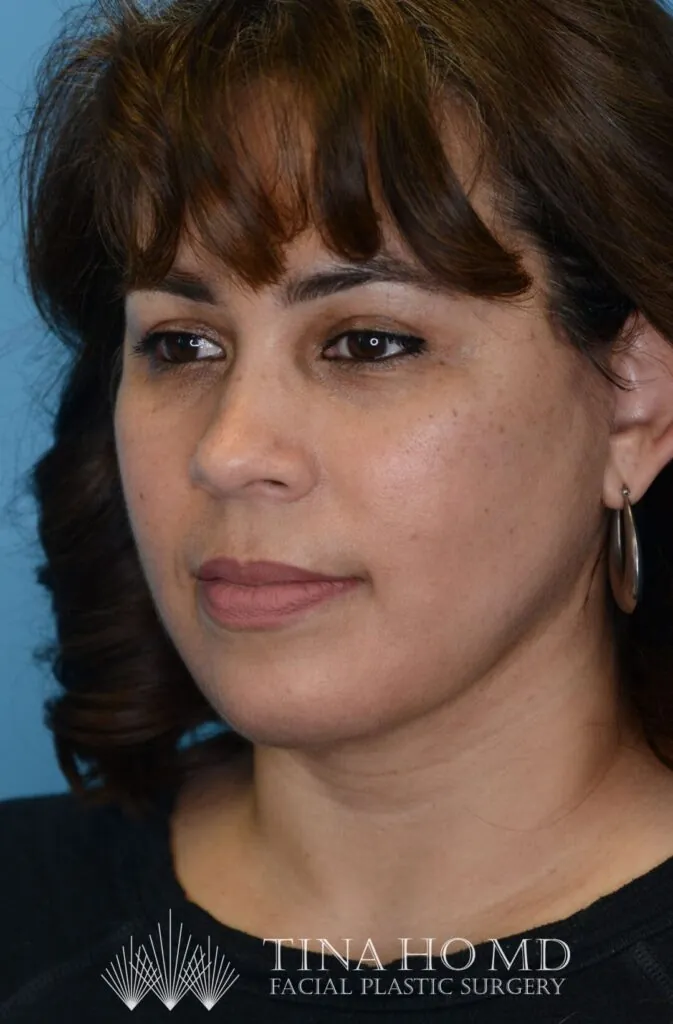 Patient LR's left oblique view, showing improved facial contours after surgery