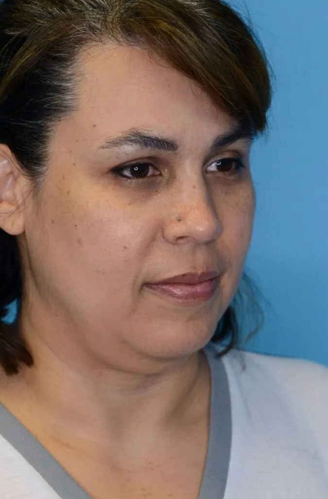 Patient LR's right oblique view, before facelift surgery