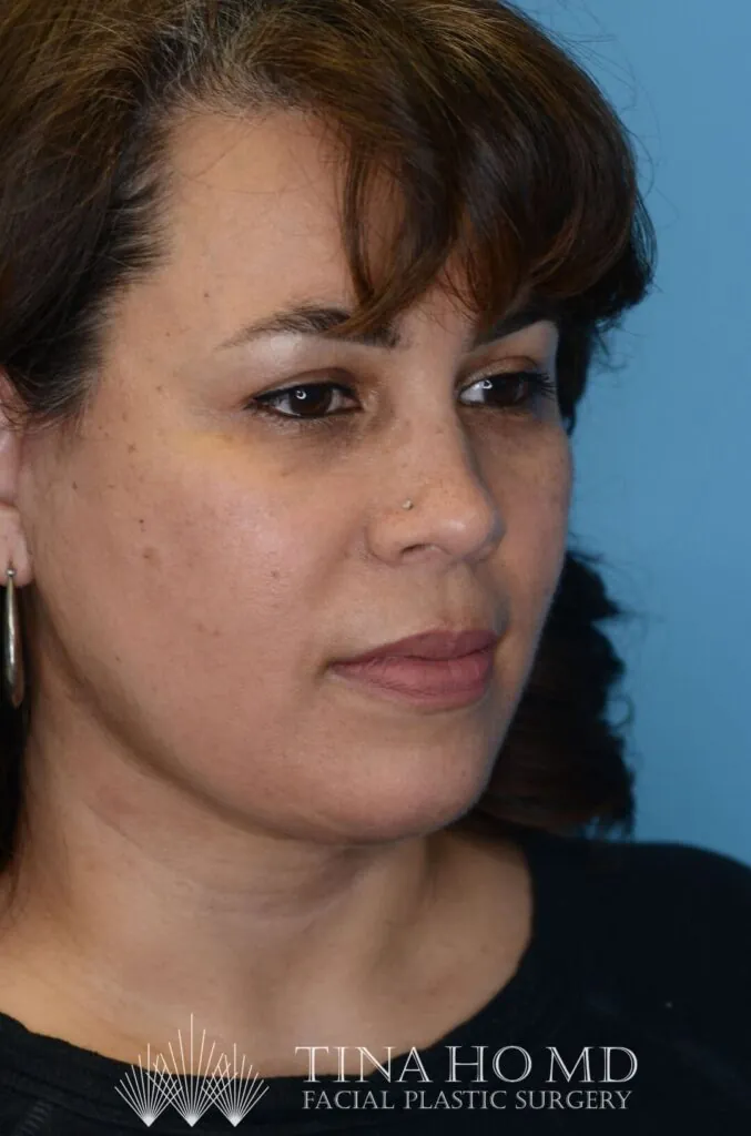 Patient LR's right oblique view, showing improved facial contours after surgery