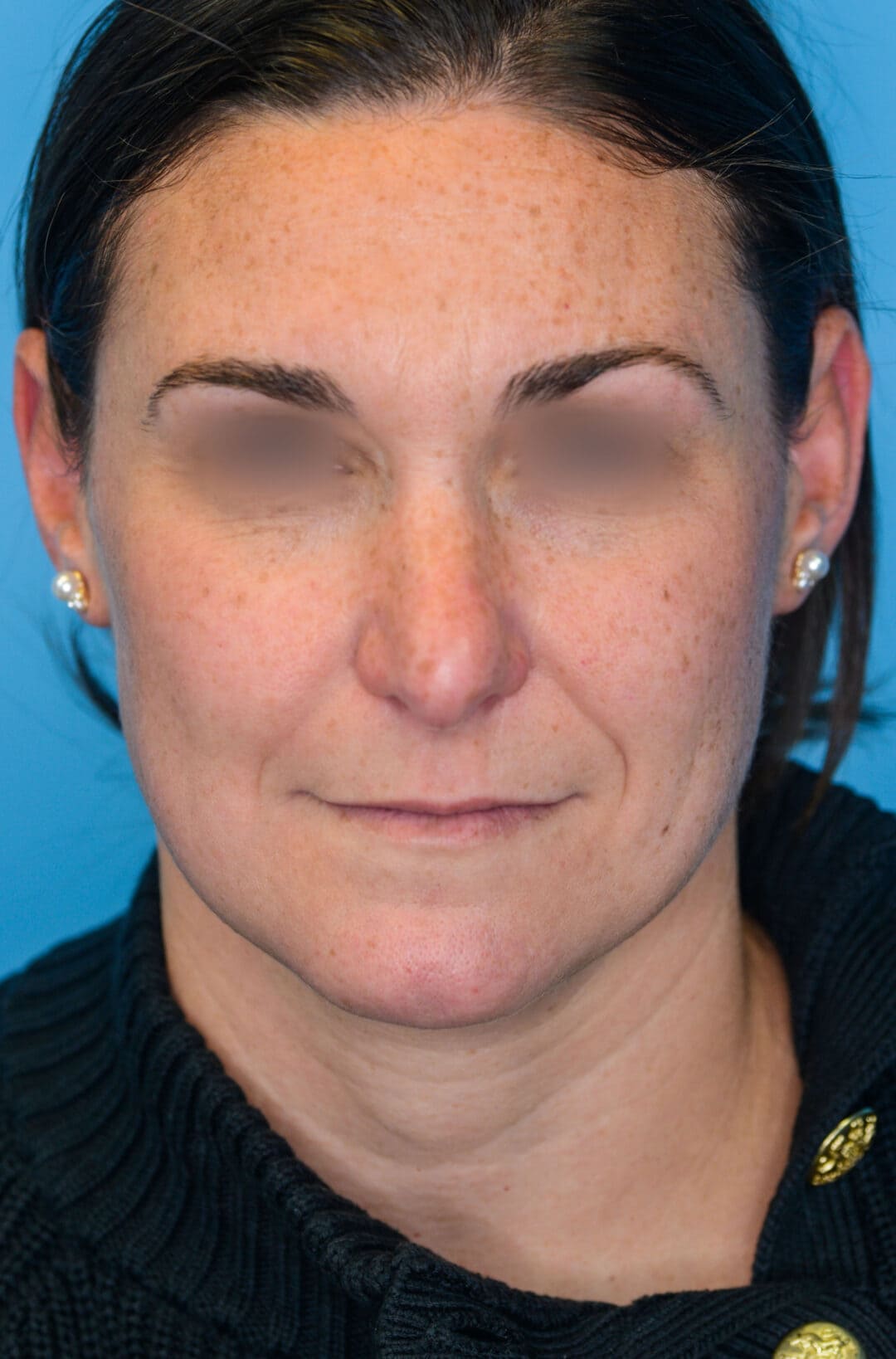 Patient ML's frontal view before rhinoplasty surgery