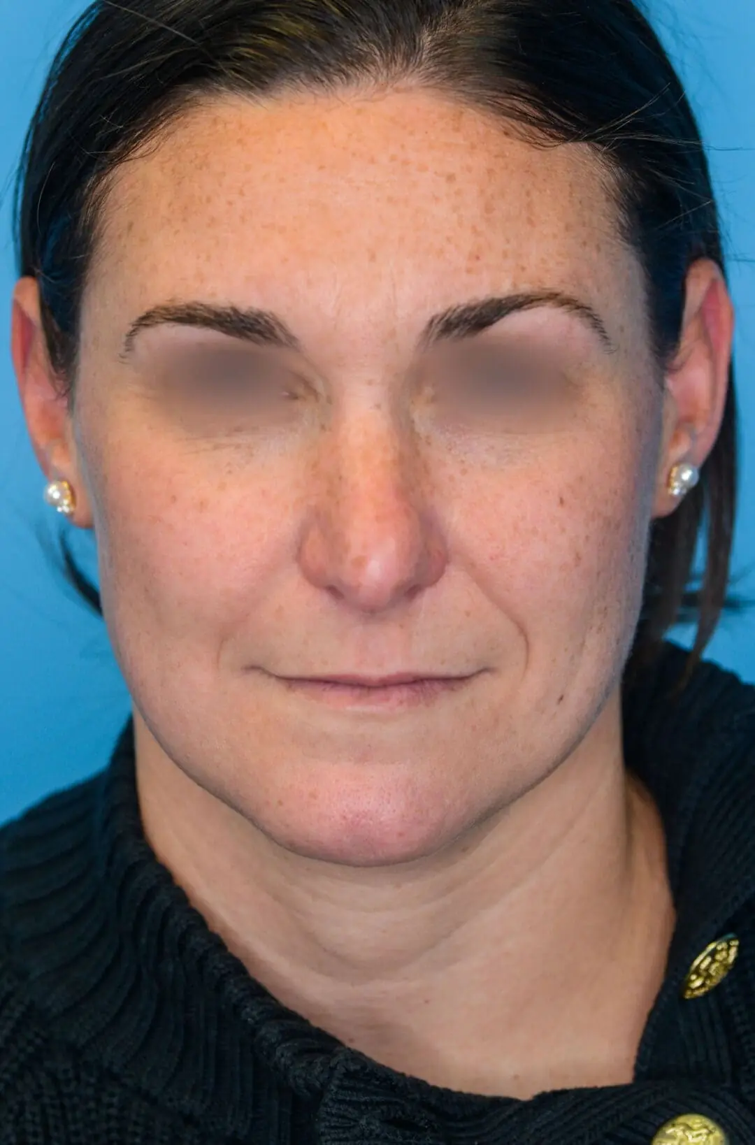 Patient ML's frontal view before rhinoplasty surgery