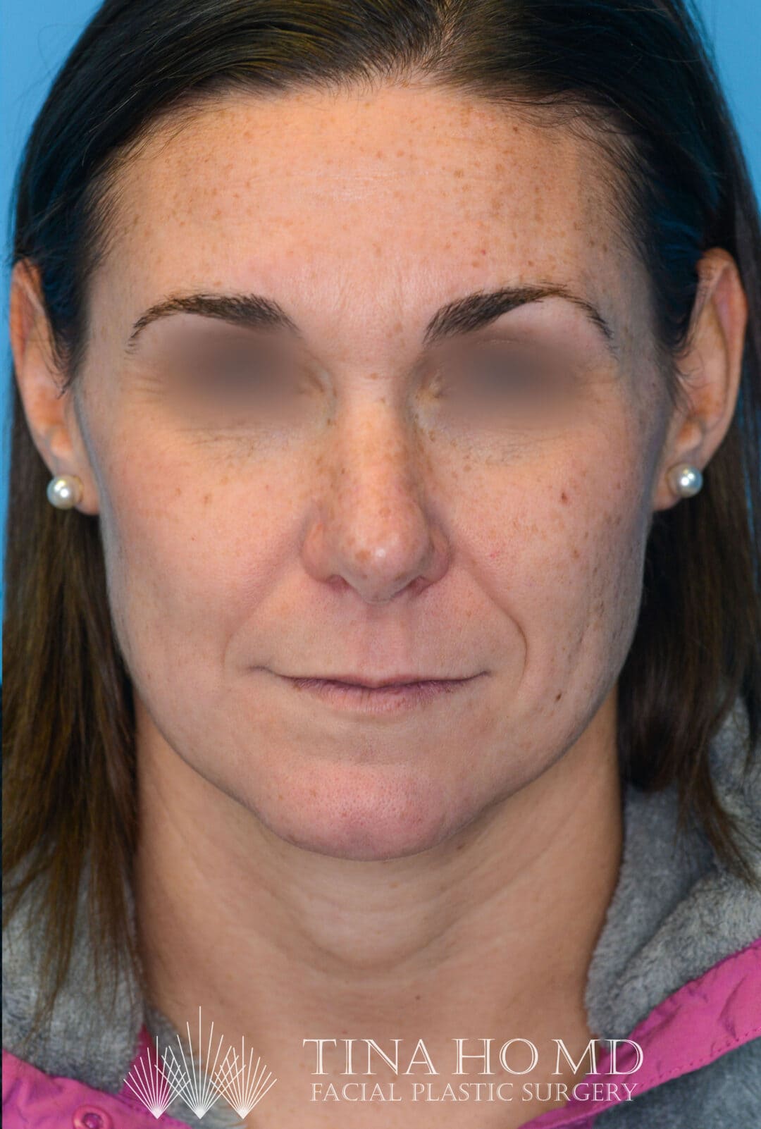 Patient ML's improved frontal view after rhinoplasty surgery