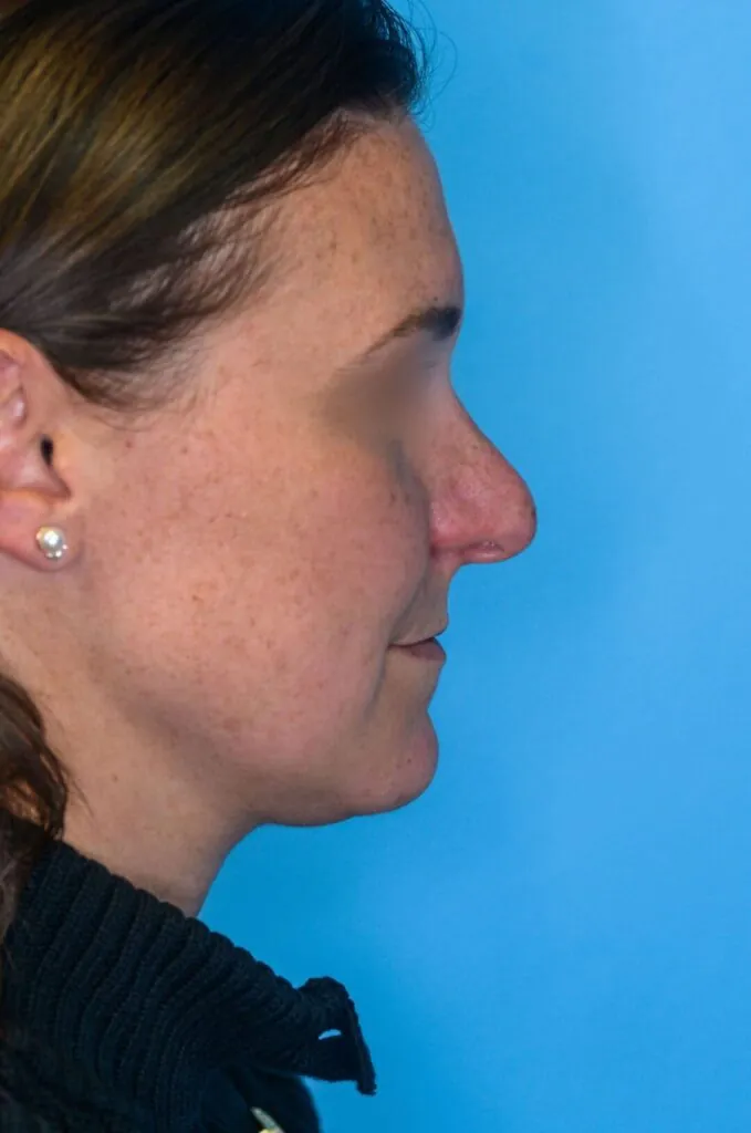 Patient ML's right lateral profile before rhinoplasty surgery