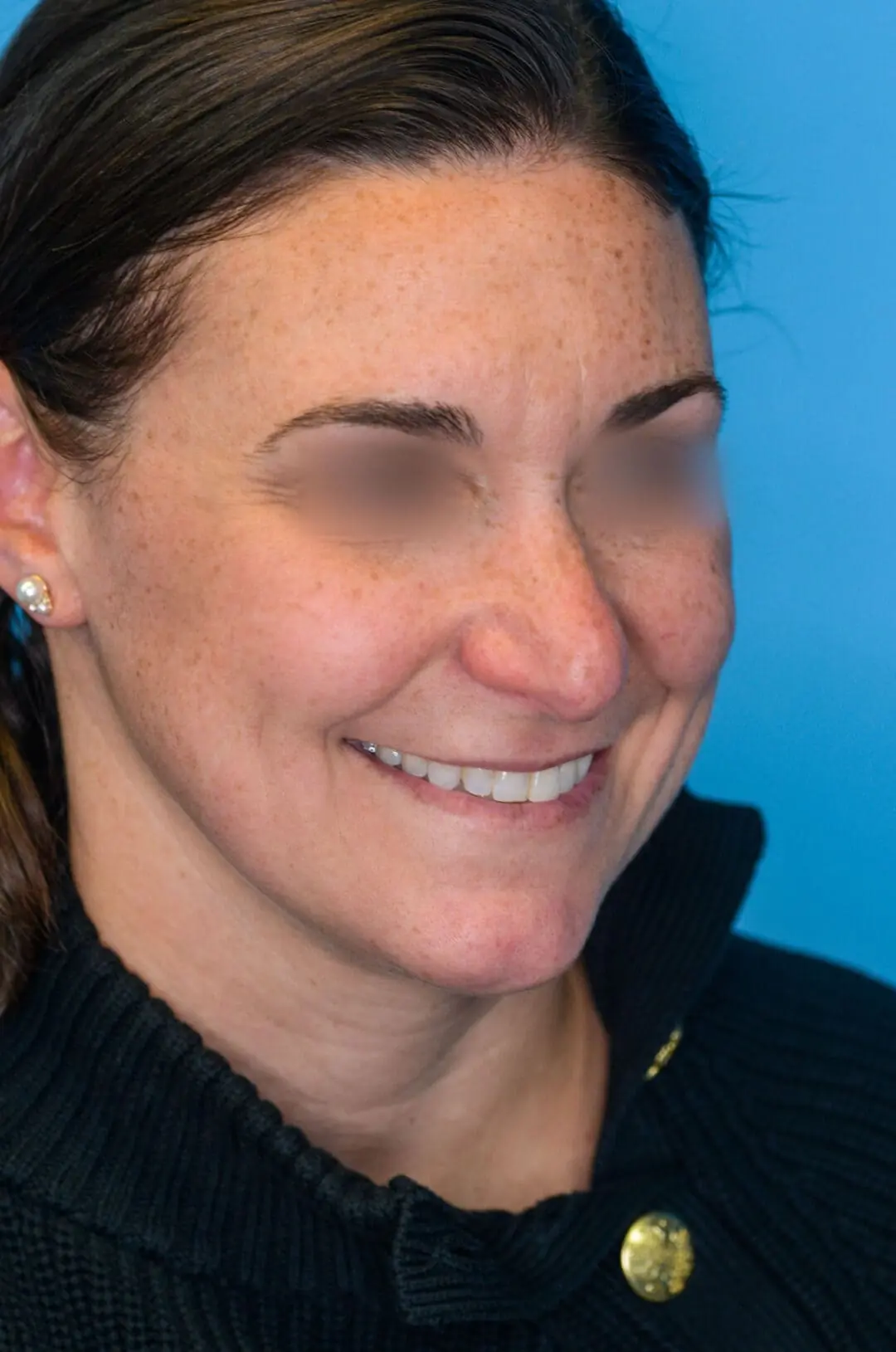 Patient ML's second right oblique view before rhinoplasty